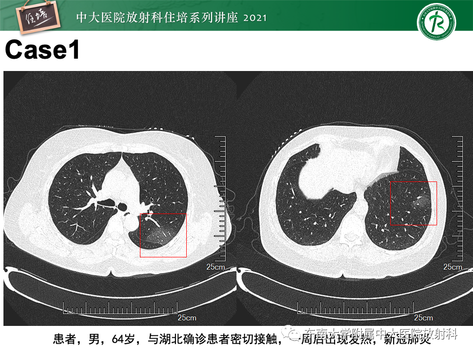 影像PPT - 【PPT】常见细菌性肺炎与病毒性肺炎的鉴别诊断（以COVID-19为例）-7