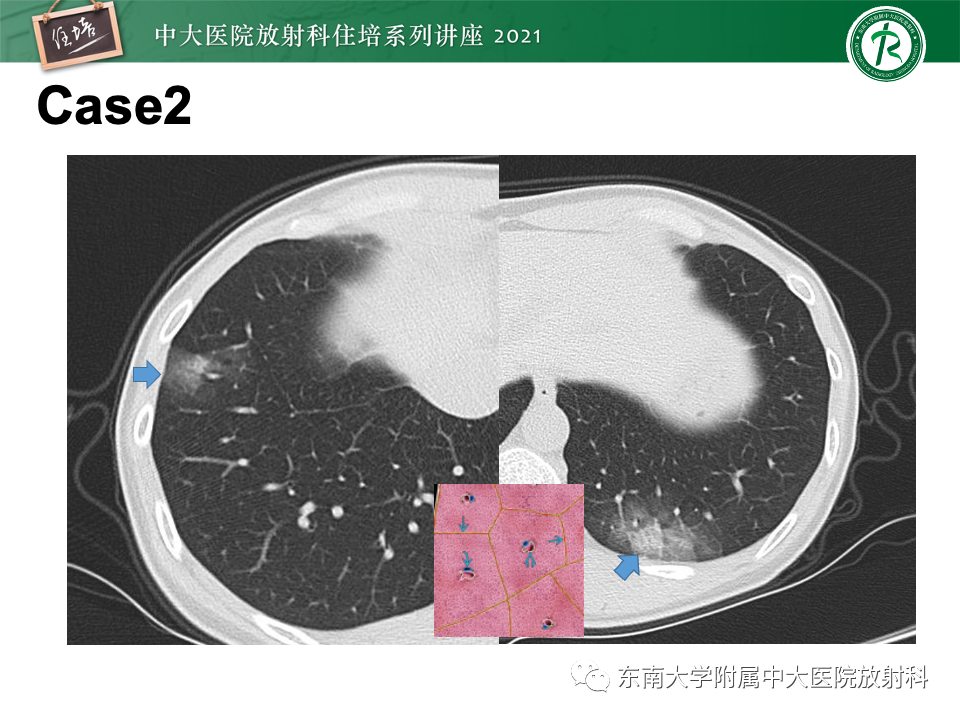 影像PPT - 【PPT】常见细菌性肺炎与病毒性肺炎的鉴别诊断（以COVID-19为例）-8