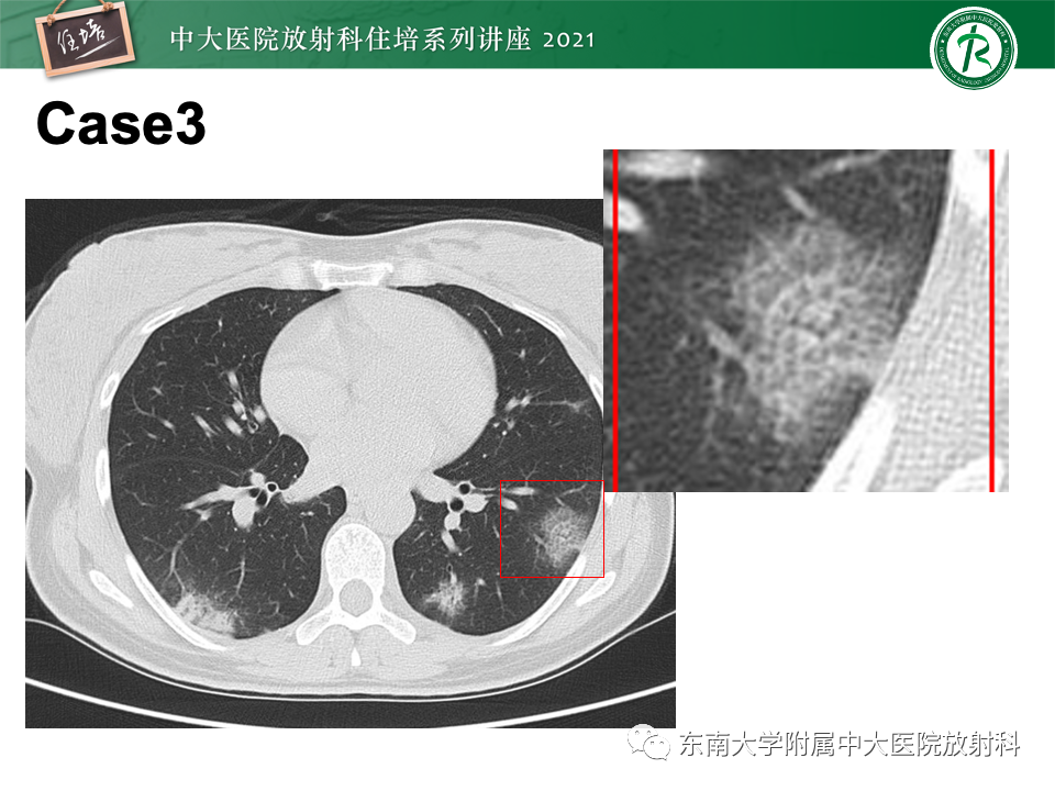 影像PPT - 【PPT】常见细菌性肺炎与病毒性肺炎的鉴别诊断（以COVID-19为例）-9