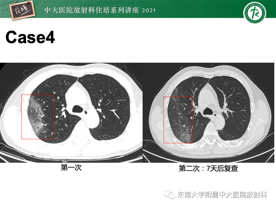 影像PPT - 【PPT】常见细菌性肺炎与病毒性肺炎的鉴别诊断（以COVID-19为例）-10