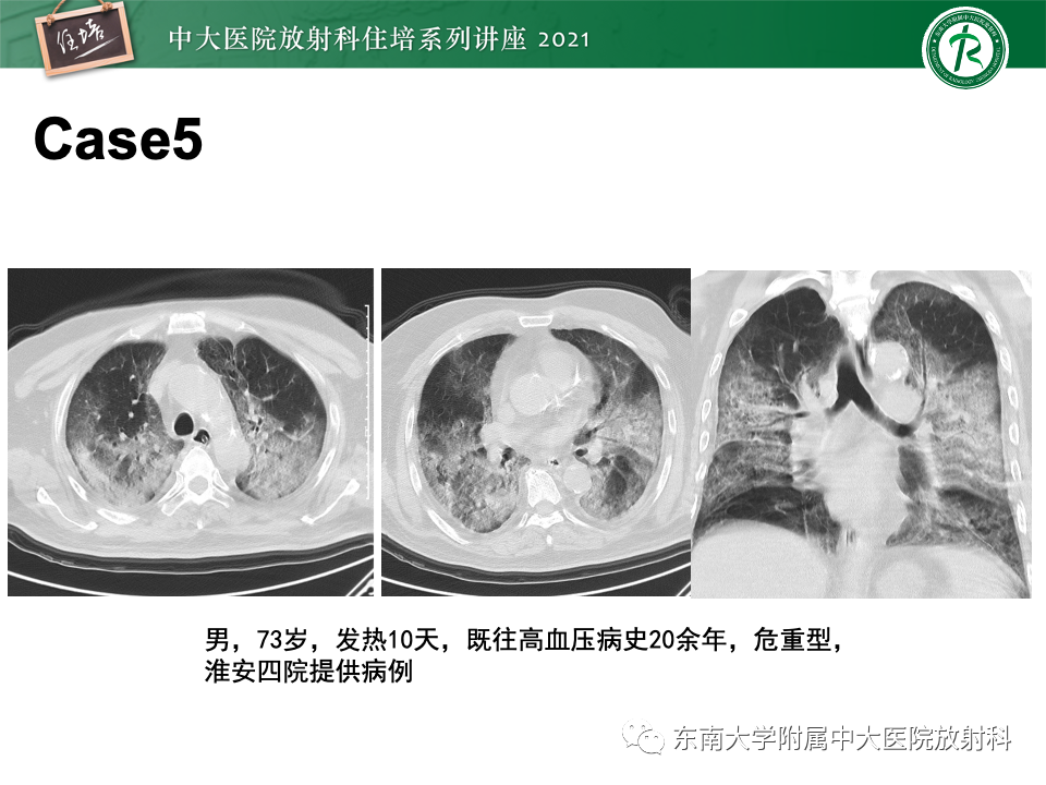 影像PPT - 【PPT】常见细菌性肺炎与病毒性肺炎的鉴别诊断（以COVID-19为例）-11