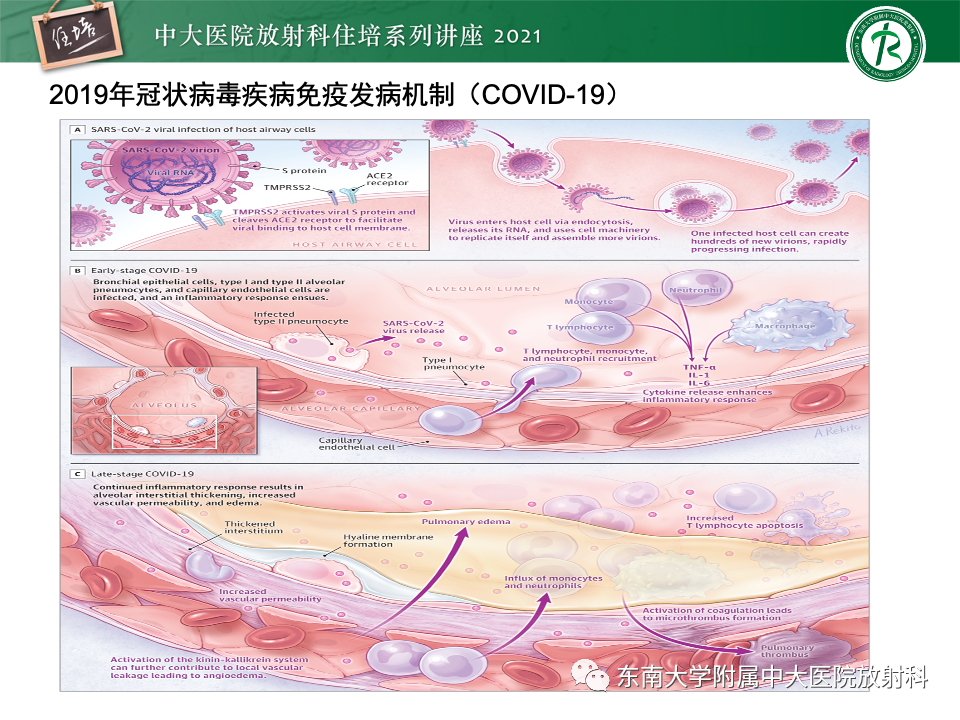 影像PPT - 【PPT】常见细菌性肺炎与病毒性肺炎的鉴别诊断（以COVID-19为例）-13