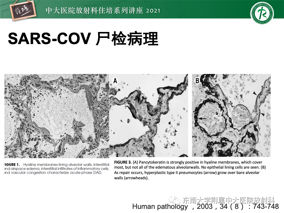 影像PPT - 【PPT】常见细菌性肺炎与病毒性肺炎的鉴别诊断（以COVID-19为例）-16