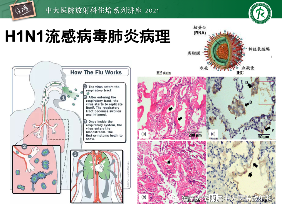 影像PPT - 【PPT】常见细菌性肺炎与病毒性肺炎的鉴别诊断（以COVID-19为例）-17