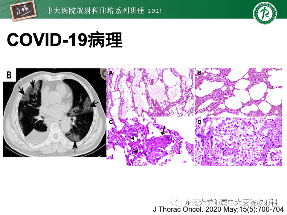 影像PPT - 【PPT】常见细菌性肺炎与病毒性肺炎的鉴别诊断（以COVID-19为例）-15