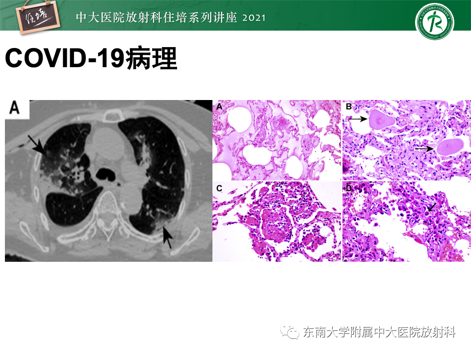 影像PPT - 【PPT】常见细菌性肺炎与病毒性肺炎的鉴别诊断（以COVID-19为例）-14