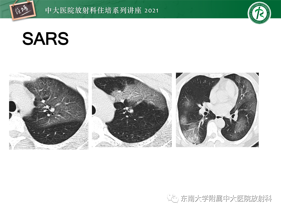 影像PPT - 【PPT】常见细菌性肺炎与病毒性肺炎的鉴别诊断（以COVID-19为例）-23