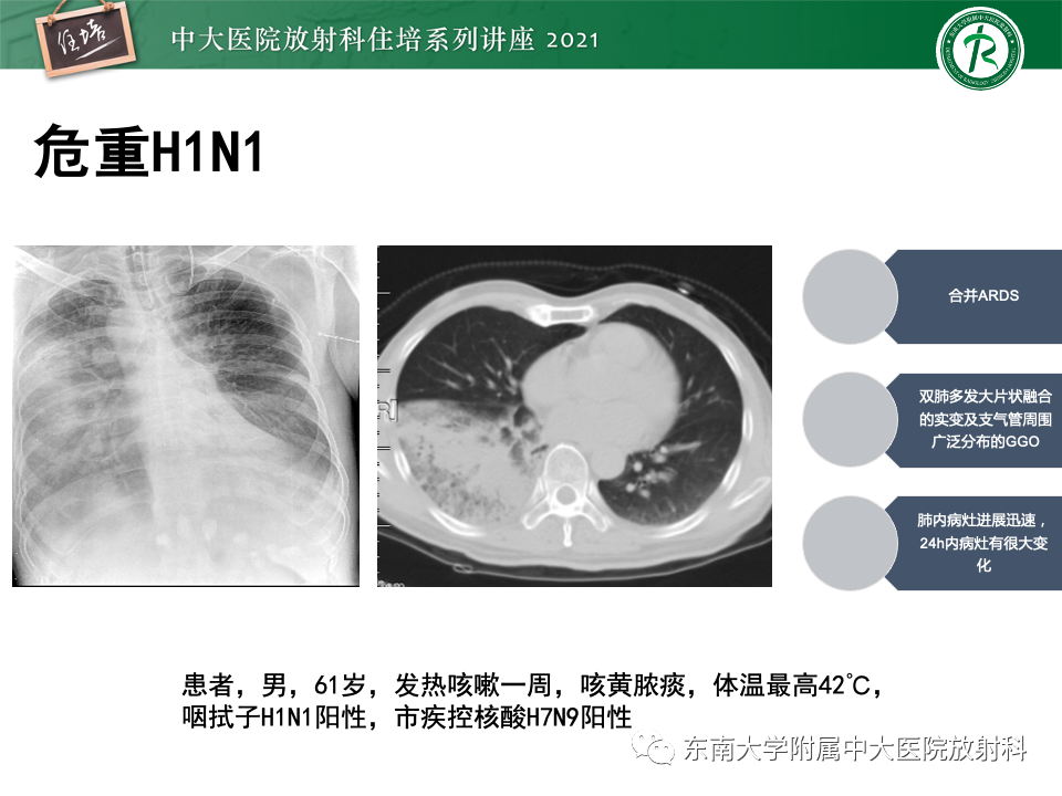 影像PPT - 【PPT】常见细菌性肺炎与病毒性肺炎的鉴别诊断（以COVID-19为例）-29