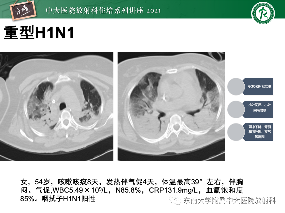 影像PPT - 【PPT】常见细菌性肺炎与病毒性肺炎的鉴别诊断（以COVID-19为例）-28