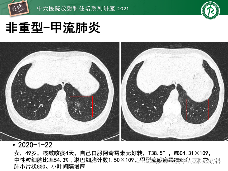 影像PPT - 【PPT】常见细菌性肺炎与病毒性肺炎的鉴别诊断（以COVID-19为例）-27