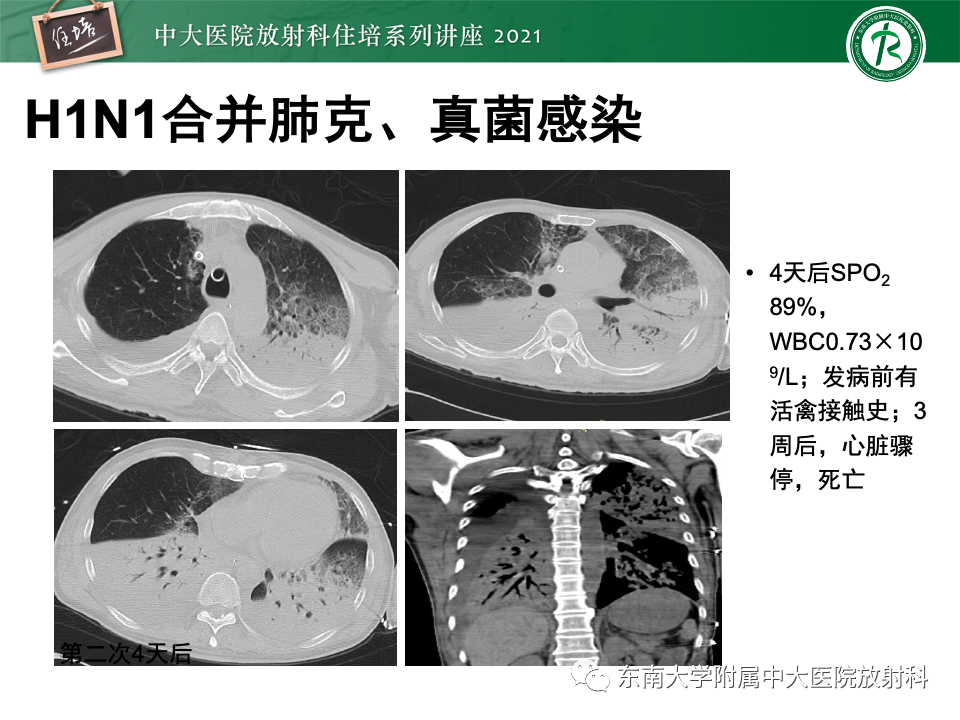 影像PPT - 【PPT】常见细菌性肺炎与病毒性肺炎的鉴别诊断（以COVID-19为例）-30