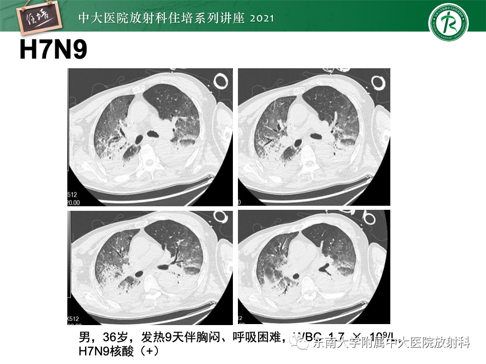 影像PPT - 【PPT】常见细菌性肺炎与病毒性肺炎的鉴别诊断（以COVID-19为例）-31