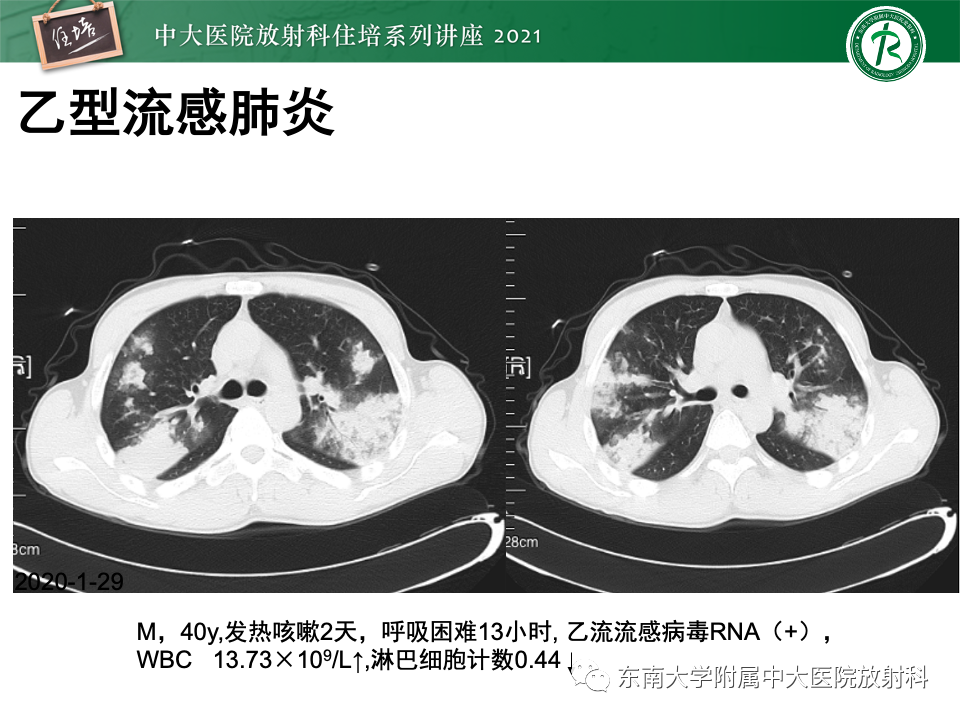 影像PPT - 【PPT】常见细菌性肺炎与病毒性肺炎的鉴别诊断（以COVID-19为例）-32