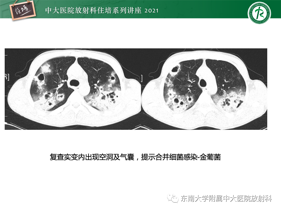 影像PPT - 【PPT】常见细菌性肺炎与病毒性肺炎的鉴别诊断（以COVID-19为例）-33