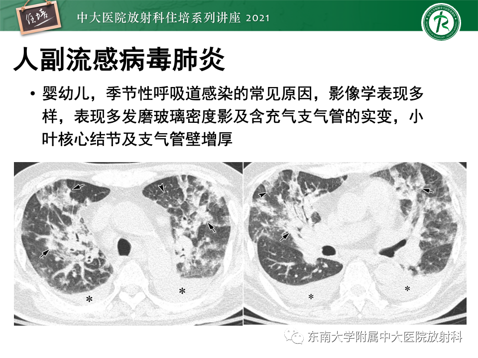 影像PPT - 【PPT】常见细菌性肺炎与病毒性肺炎的鉴别诊断（以COVID-19为例）-34