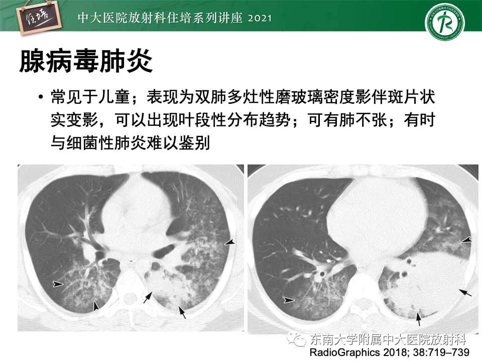 影像PPT - 【PPT】常见细菌性肺炎与病毒性肺炎的鉴别诊断（以COVID-19为例）-35