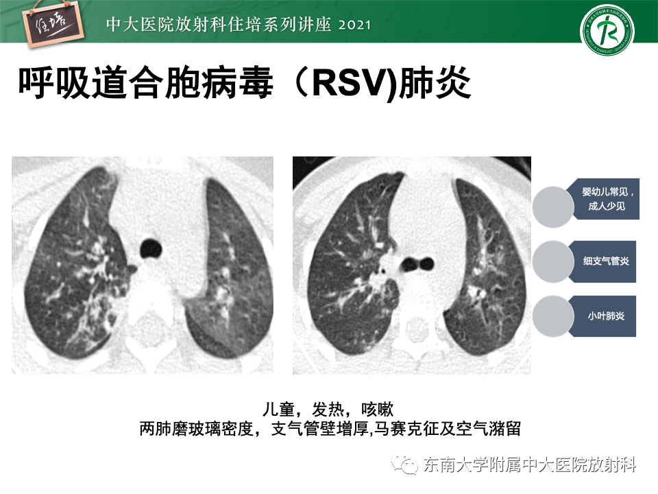 影像PPT - 【PPT】常见细菌性肺炎与病毒性肺炎的鉴别诊断（以COVID-19为例）-36
