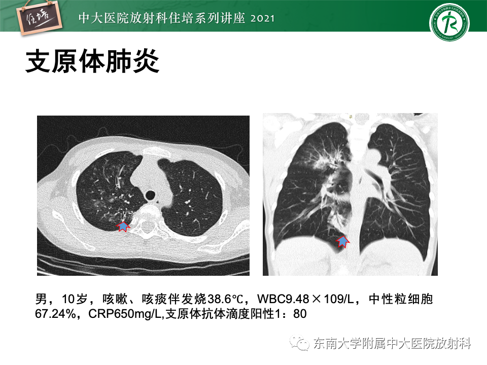 影像PPT - 【PPT】常见细菌性肺炎与病毒性肺炎的鉴别诊断（以COVID-19为例）-38