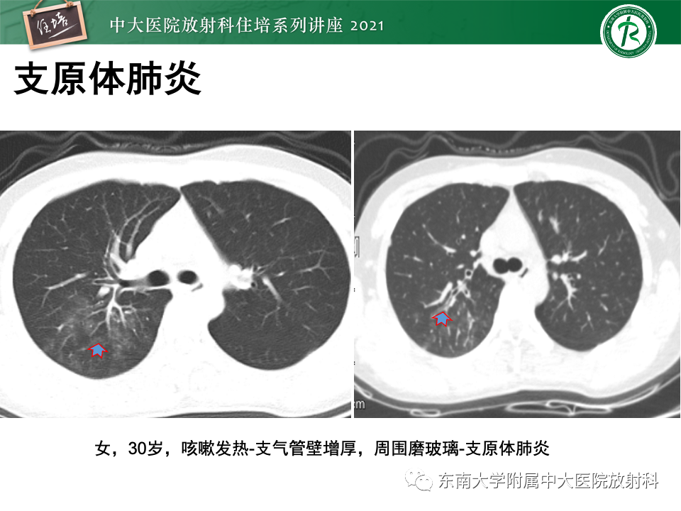 影像PPT - 【PPT】常见细菌性肺炎与病毒性肺炎的鉴别诊断（以COVID-19为例）-40