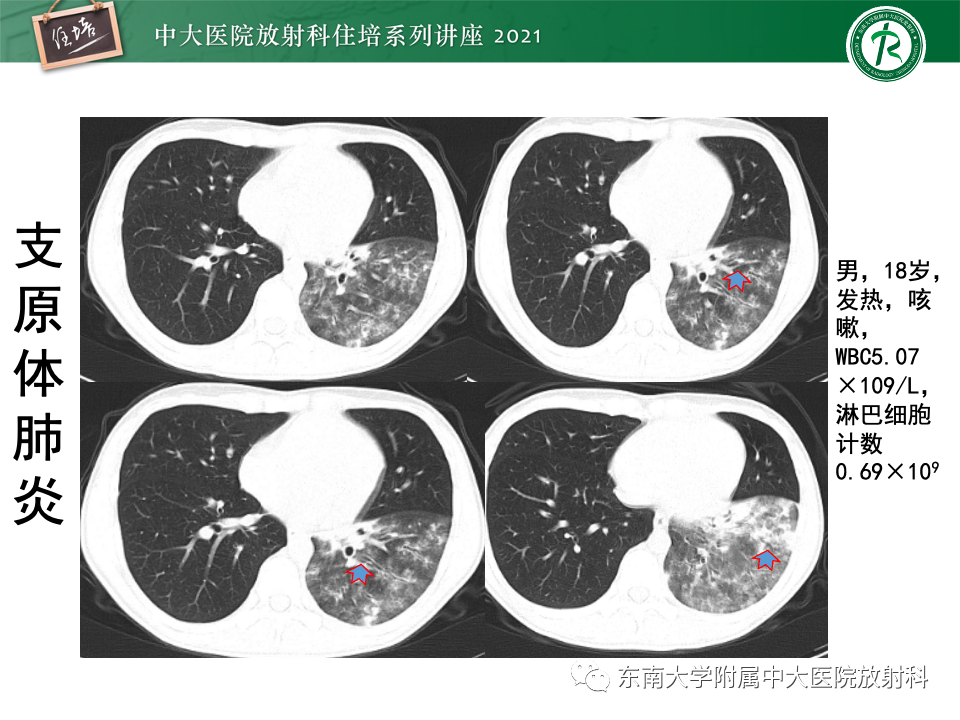 影像PPT - 【PPT】常见细菌性肺炎与病毒性肺炎的鉴别诊断（以COVID-19为例）-39