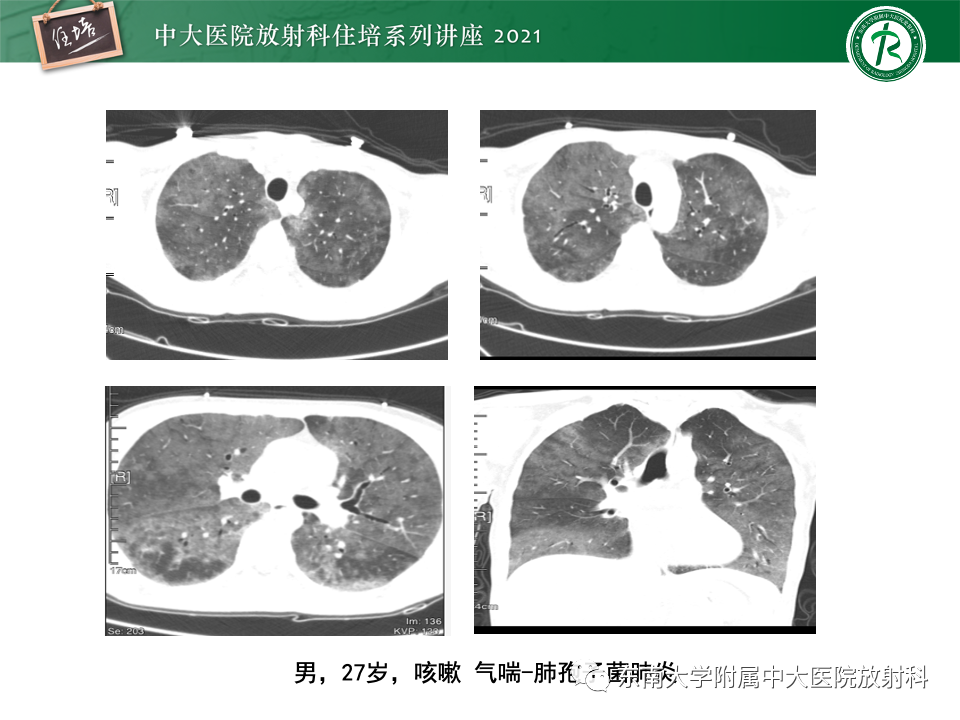 影像PPT - 【PPT】常见细菌性肺炎与病毒性肺炎的鉴别诊断（以COVID-19为例）-43