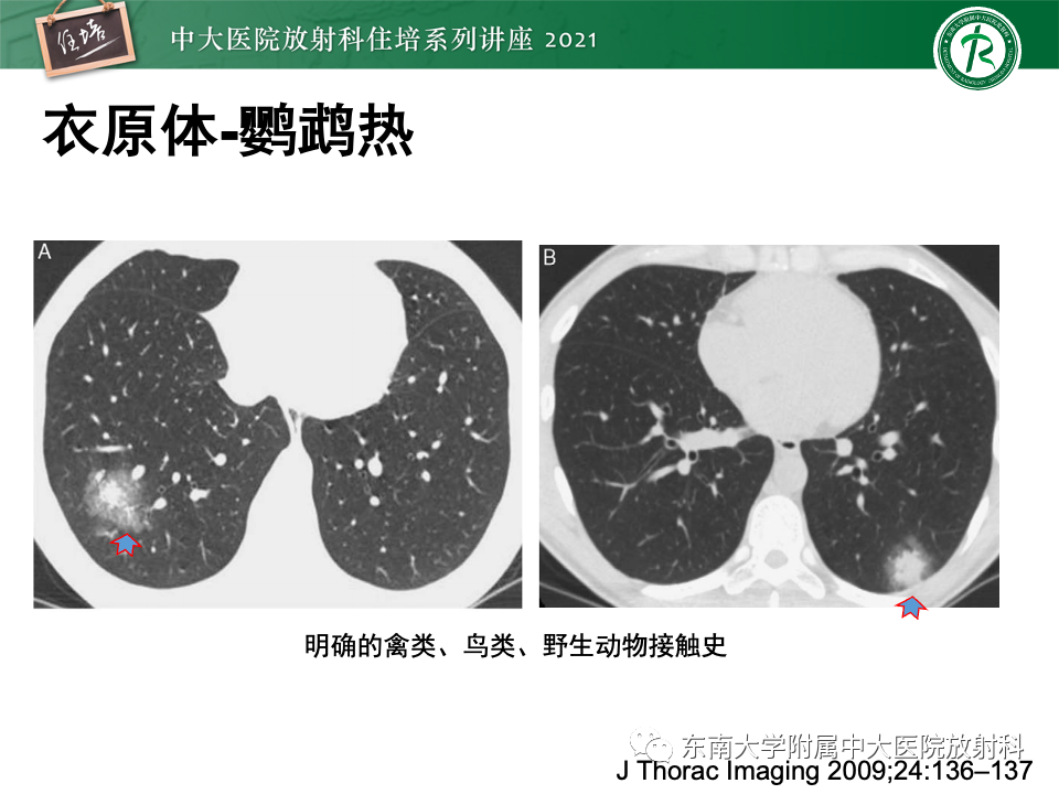 影像PPT - 【PPT】常见细菌性肺炎与病毒性肺炎的鉴别诊断（以COVID-19为例）-41