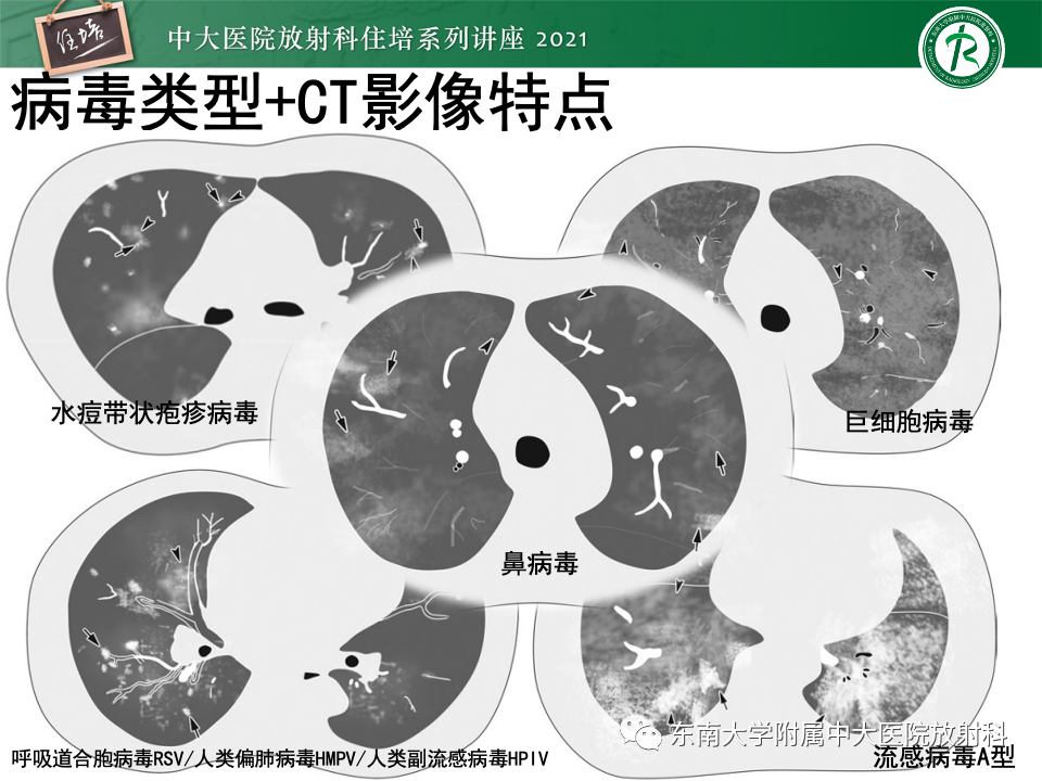 影像PPT - 【PPT】常见细菌性肺炎与病毒性肺炎的鉴别诊断（以COVID-19为例）-44