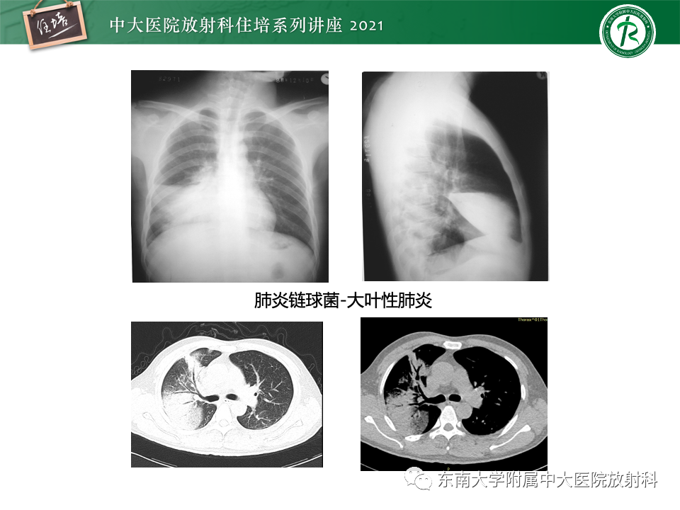 影像PPT - 【PPT】常见细菌性肺炎与病毒性肺炎的鉴别诊断（以COVID-19为例）-48