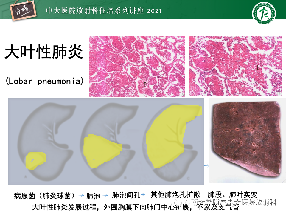 影像PPT - 【PPT】常见细菌性肺炎与病毒性肺炎的鉴别诊断（以COVID-19为例）-47
