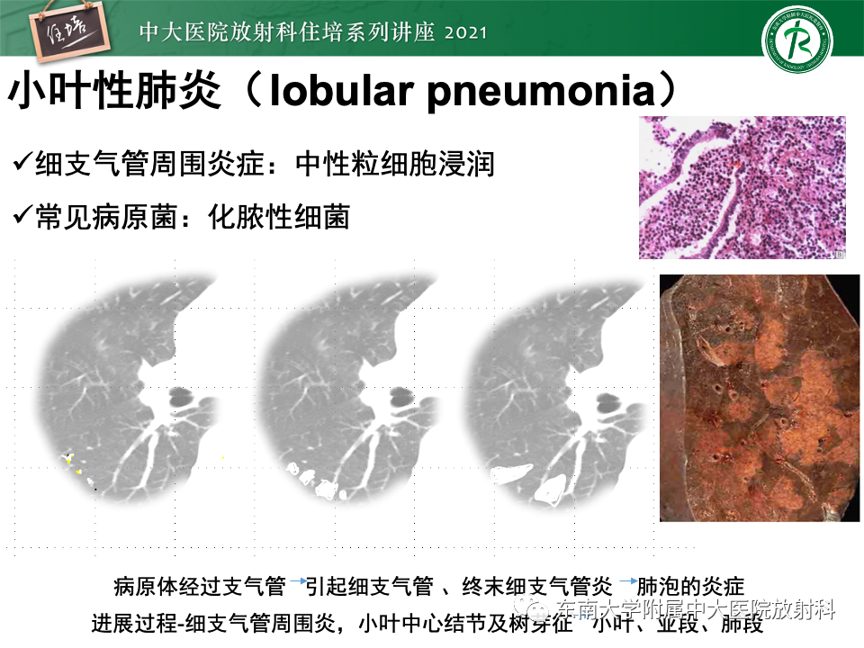影像PPT - 【PPT】常见细菌性肺炎与病毒性肺炎的鉴别诊断（以COVID-19为例）-49