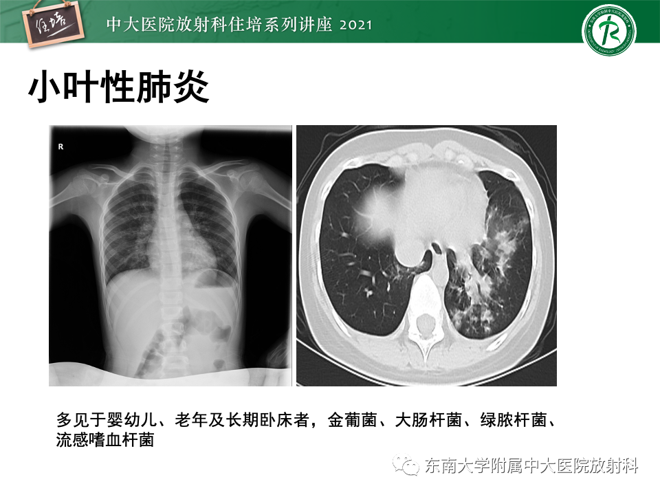 影像PPT - 【PPT】常见细菌性肺炎与病毒性肺炎的鉴别诊断（以COVID-19为例）-50