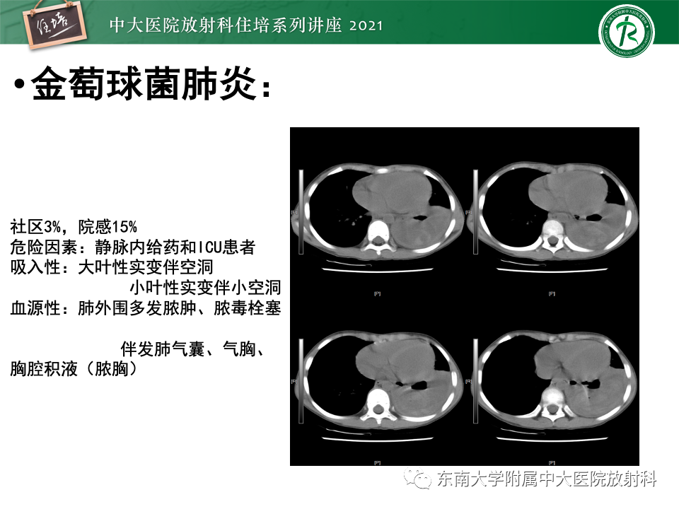 影像PPT - 【PPT】常见细菌性肺炎与病毒性肺炎的鉴别诊断（以COVID-19为例）-52