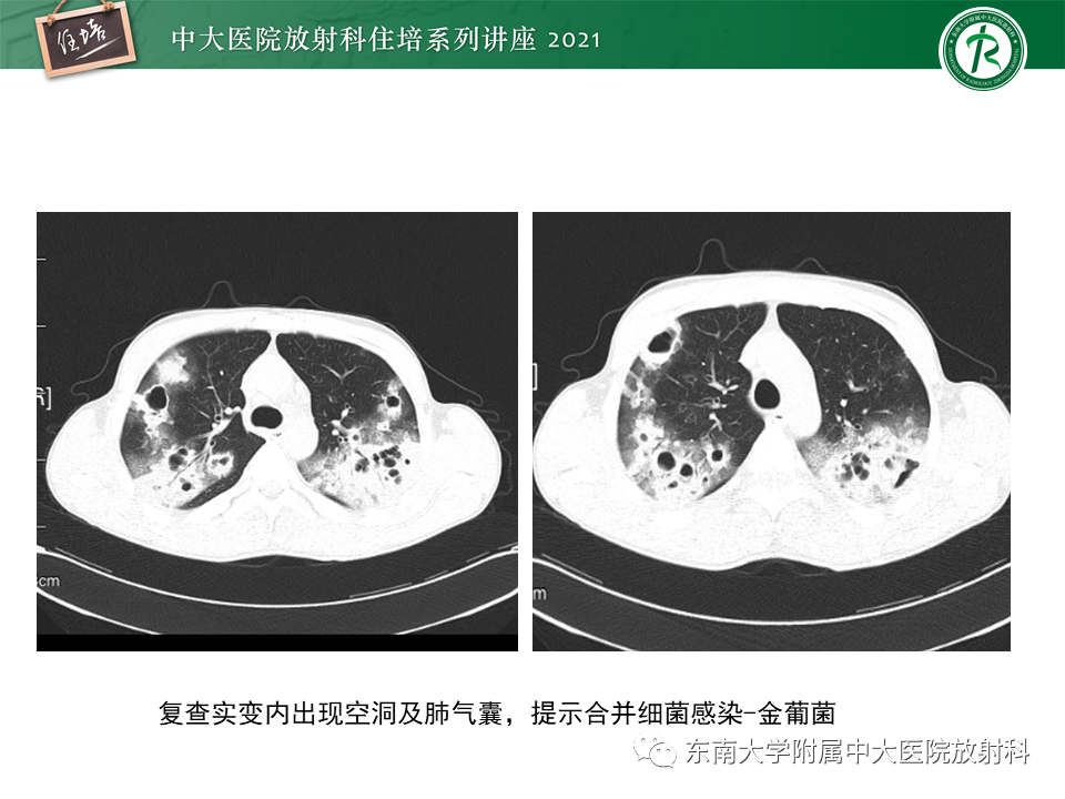 影像PPT - 【PPT】常见细菌性肺炎与病毒性肺炎的鉴别诊断（以COVID-19为例）-53