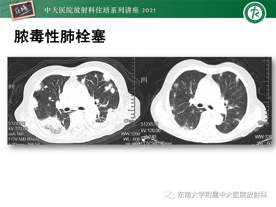 影像PPT - 【PPT】常见细菌性肺炎与病毒性肺炎的鉴别诊断（以COVID-19为例）-57