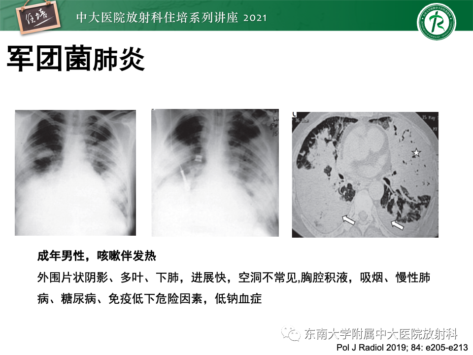 影像PPT - 【PPT】常见细菌性肺炎与病毒性肺炎的鉴别诊断（以COVID-19为例）-56