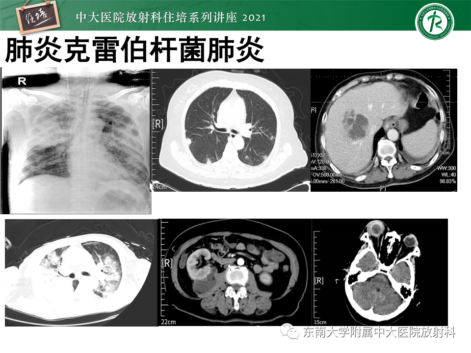 影像PPT - 【PPT】常见细菌性肺炎与病毒性肺炎的鉴别诊断（以COVID-19为例）-55
