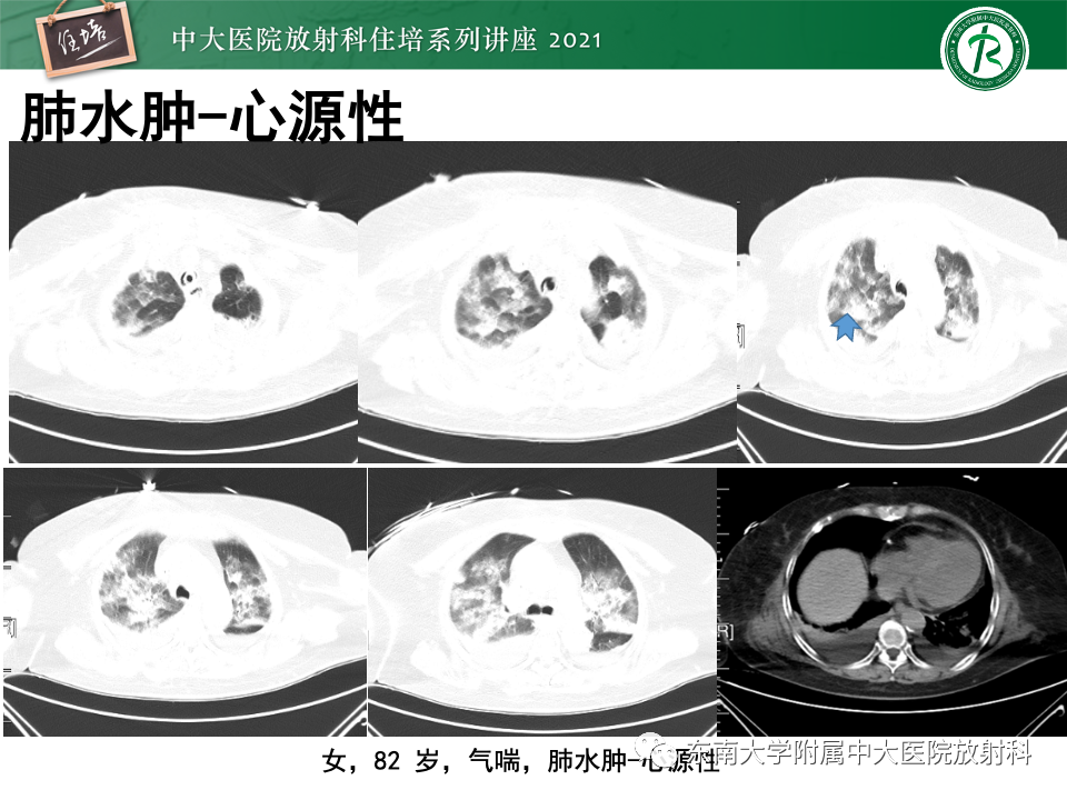 影像PPT - 【PPT】常见细菌性肺炎与病毒性肺炎的鉴别诊断（以COVID-19为例）-60