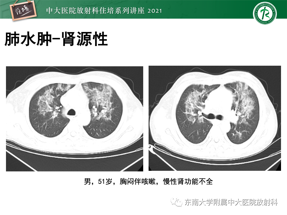影像PPT - 【PPT】常见细菌性肺炎与病毒性肺炎的鉴别诊断（以COVID-19为例）-61
