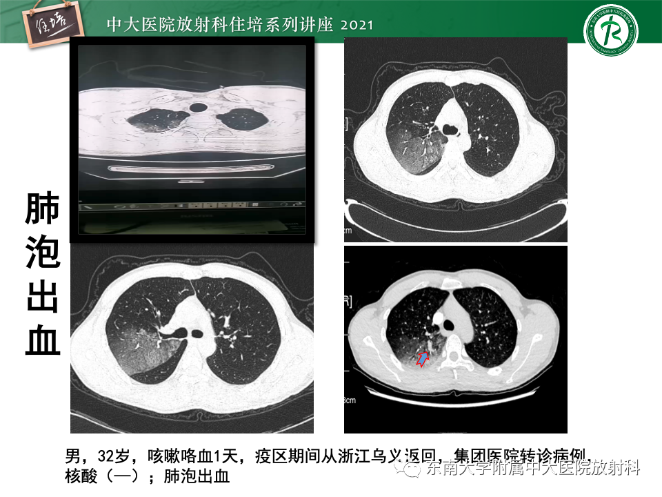 影像PPT - 【PPT】常见细菌性肺炎与病毒性肺炎的鉴别诊断（以COVID-19为例）-62