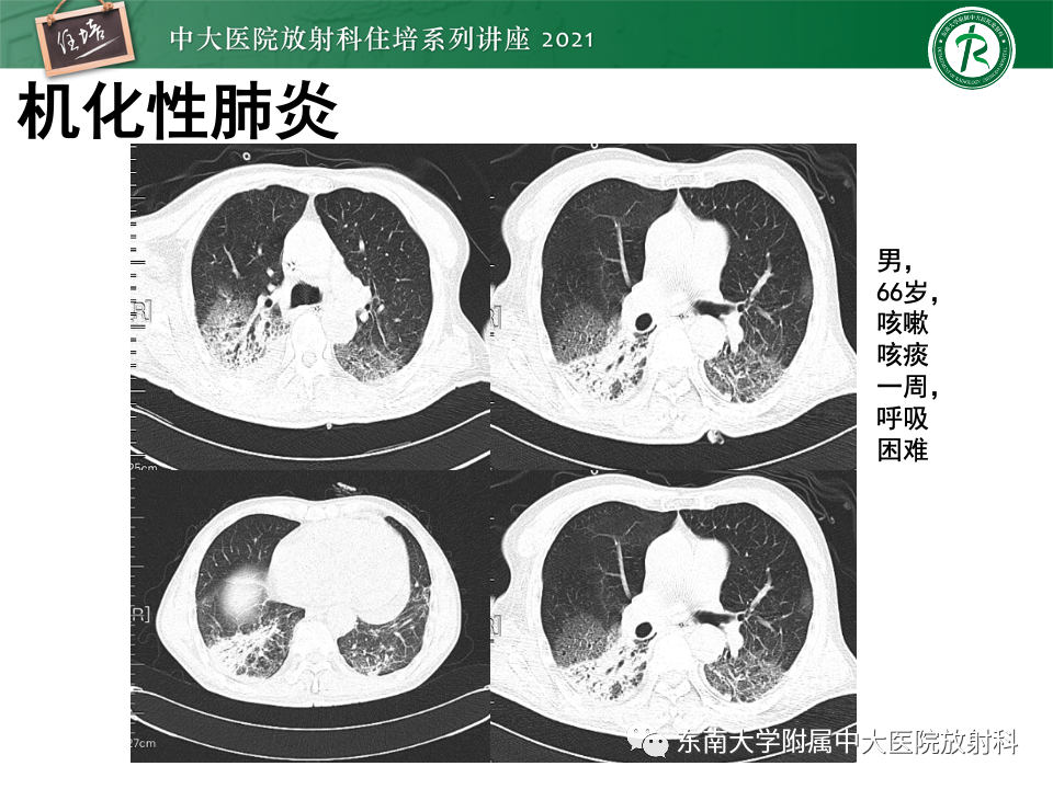 影像PPT - 【PPT】常见细菌性肺炎与病毒性肺炎的鉴别诊断（以COVID-19为例）-63