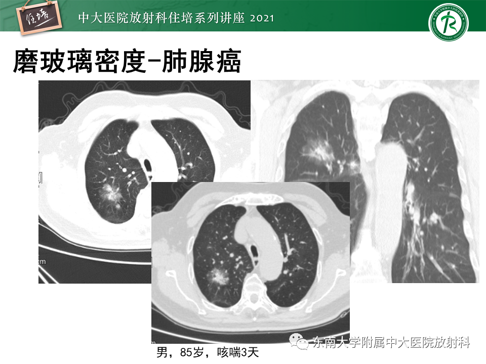 影像PPT - 【PPT】常见细菌性肺炎与病毒性肺炎的鉴别诊断（以COVID-19为例）-64