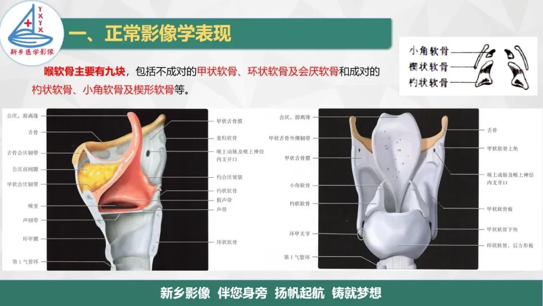 影像PPT - 【PPT】医学影像诊断学教材解读—喉部疾病-4