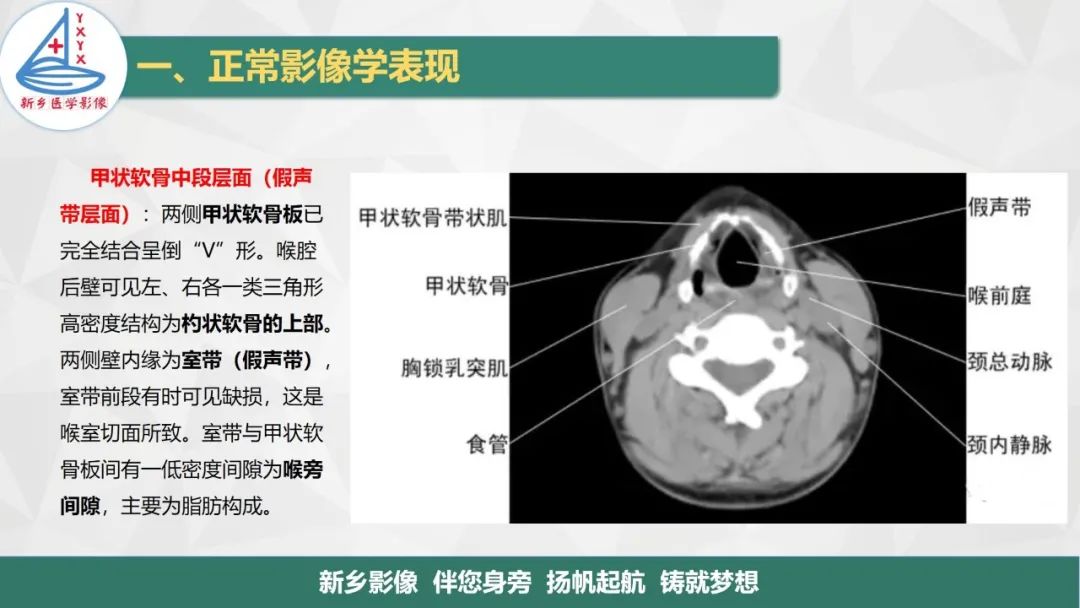 影像PPT - 【PPT】医学影像诊断学教材解读—喉部疾病-10