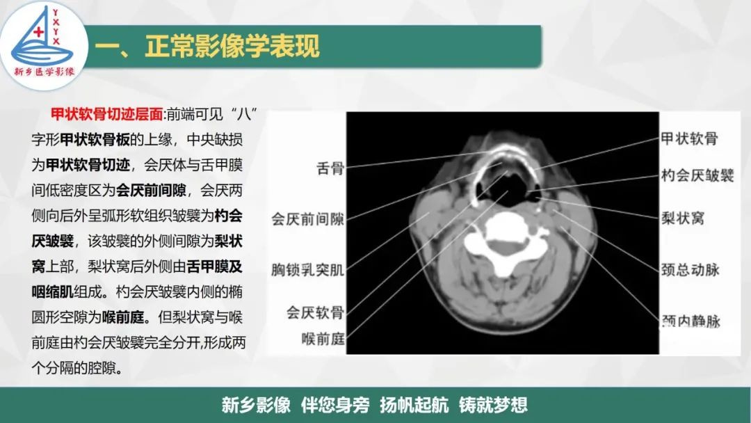 影像PPT - 【PPT】医学影像诊断学教材解读—喉部疾病-9