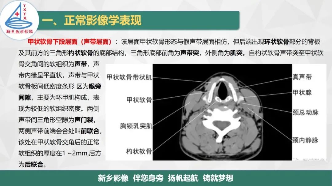 影像PPT - 【PPT】医学影像诊断学教材解读—喉部疾病-11