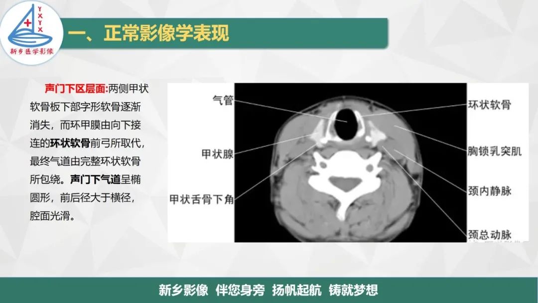 影像PPT - 【PPT】医学影像诊断学教材解读—喉部疾病-12