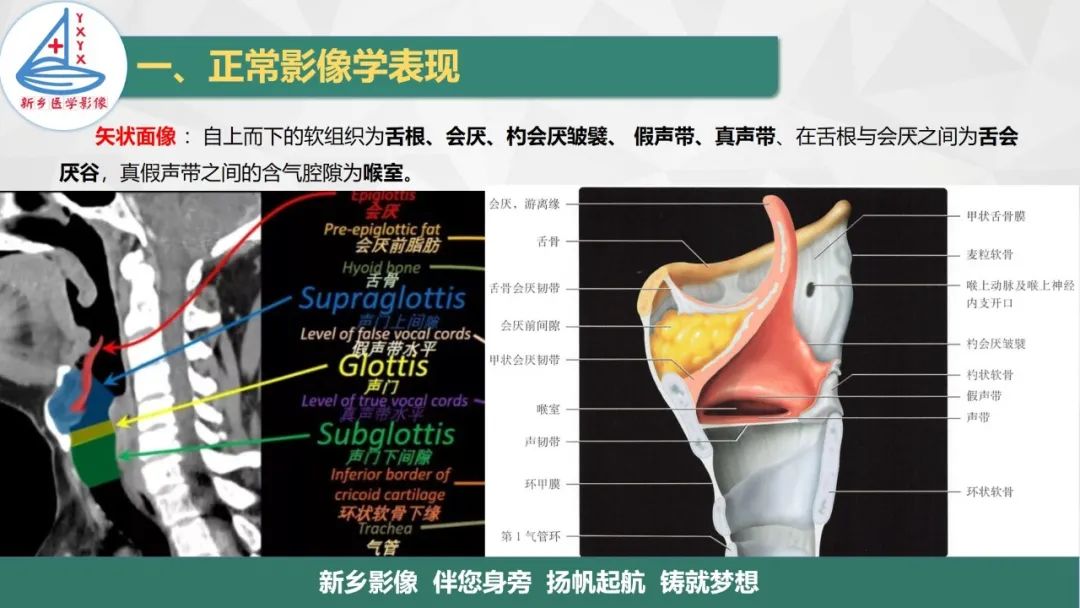 影像PPT - 【PPT】医学影像诊断学教材解读—喉部疾病-13