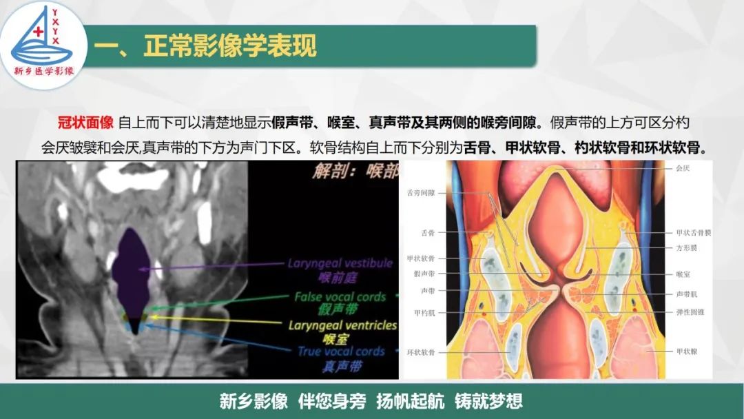 影像PPT - 【PPT】医学影像诊断学教材解读—喉部疾病-14