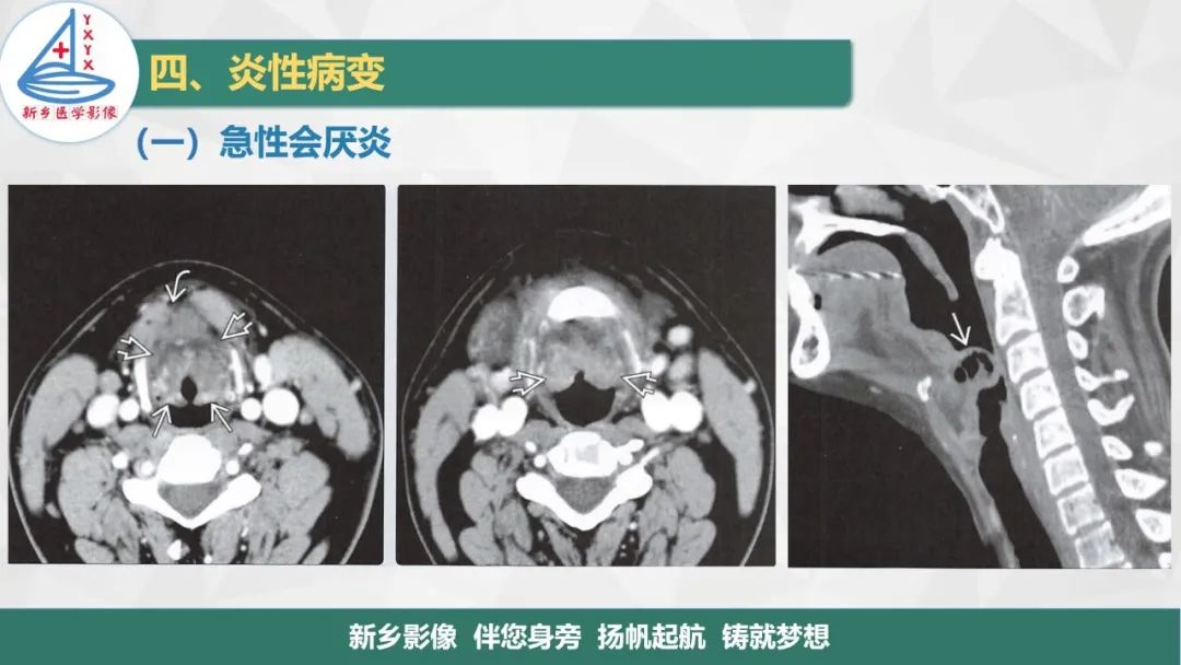 影像PPT - 【PPT】医学影像诊断学教材解读—喉部疾病-20