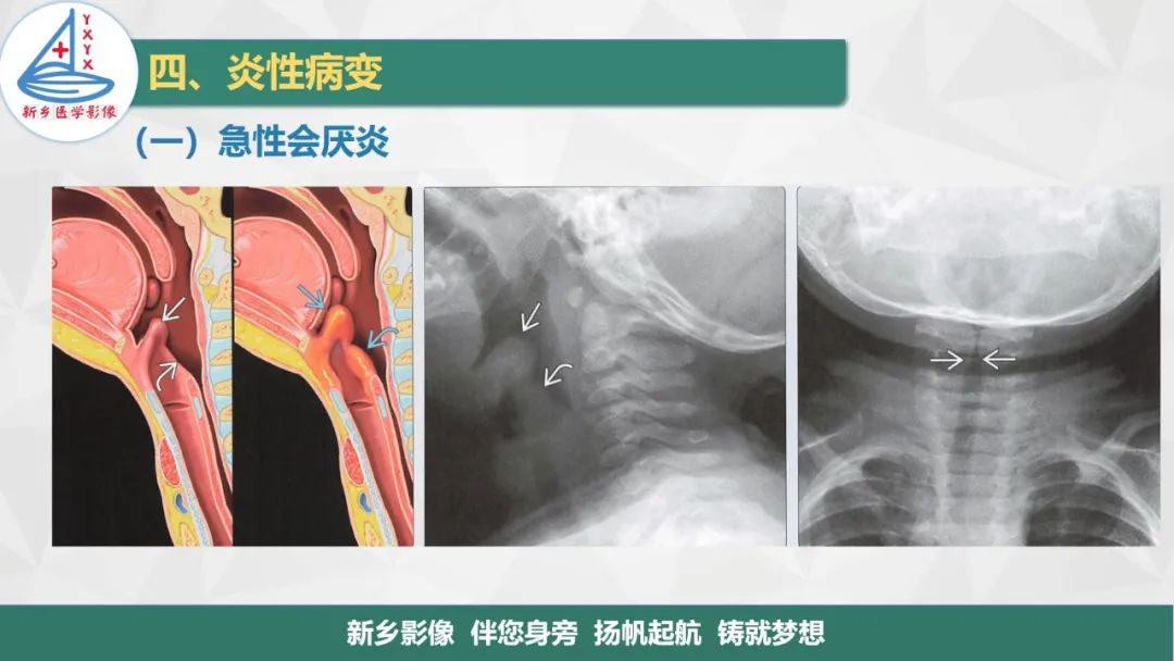 影像PPT - 【PPT】医学影像诊断学教材解读—喉部疾病-19